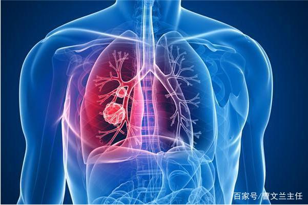 检测报告上的“肺小结节”是啥？需要手术吗？会癌变吗？(图2)