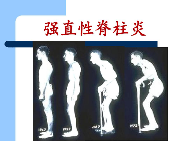 年轻人夜里腰背痛、醒来“晨僵”？当心强直性脊柱炎(图1)