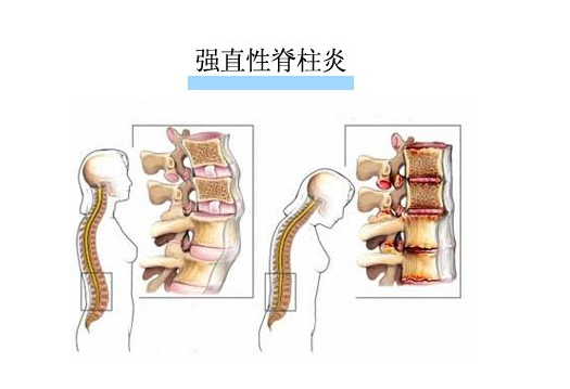 年轻人夜里腰背痛、醒来“晨僵”？当心强直性脊柱炎(图2)