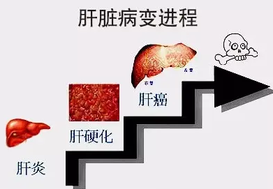 肝炎拖成肝癌……每天夺走数千人生命！ 世界肝炎日：肝炎不能等待(图2)