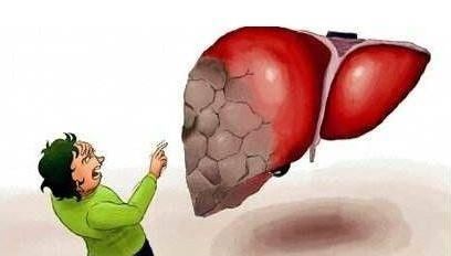 肝炎拖成肝癌……每天夺走数千人生命！ 世界肝炎日：肝炎不能等待(图3)