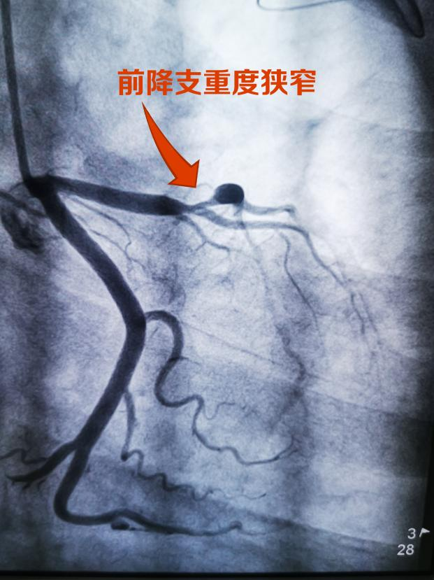 我院首例不稳定型心绞痛患者,心脏支架成功(图1)