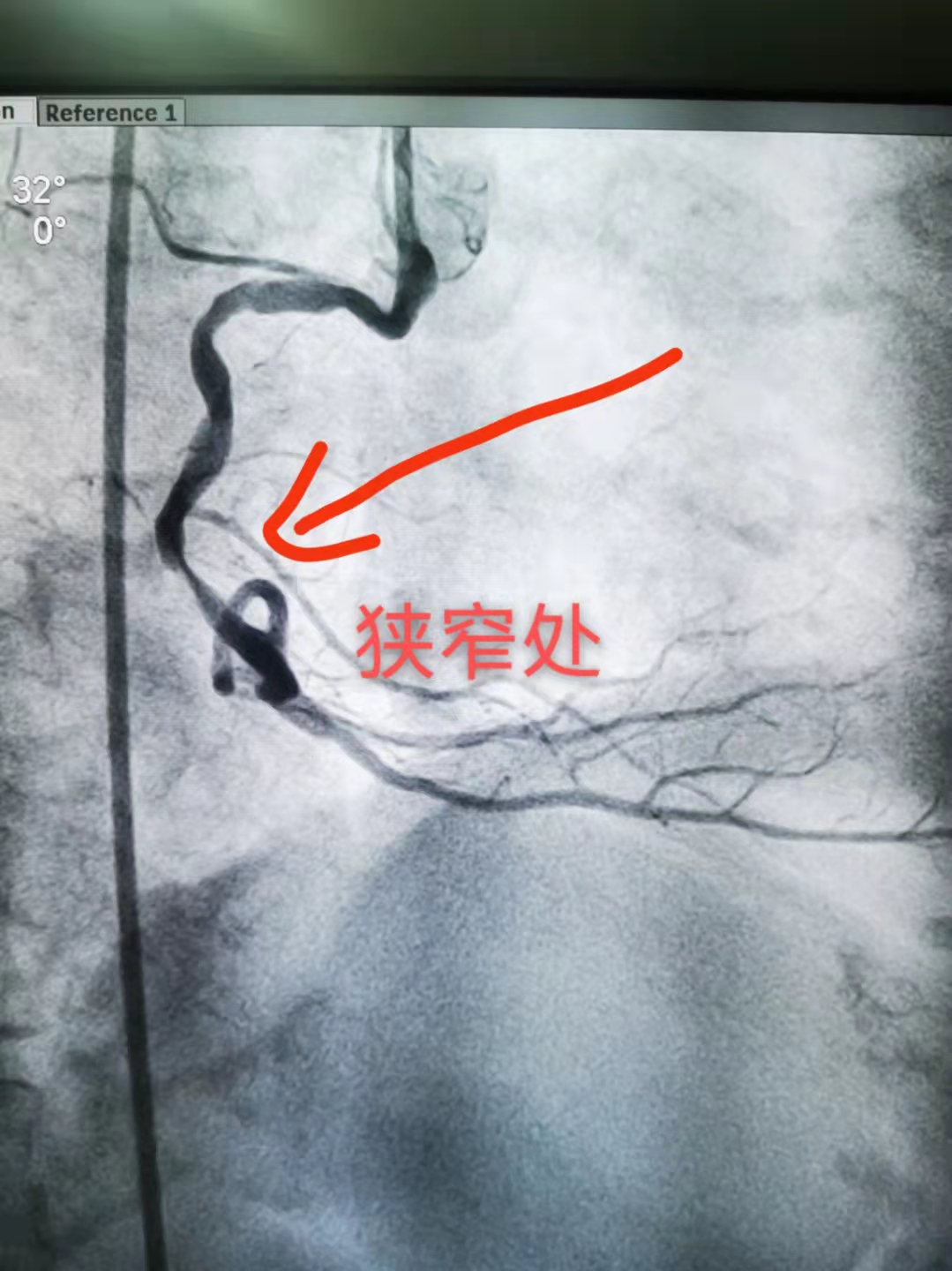 老人两次心跳骤停，多学科携手再创生命奇迹(图1)