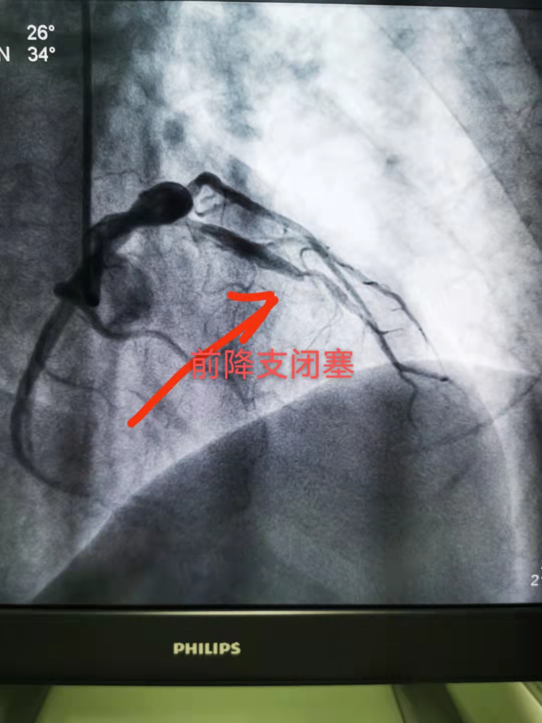 52分钟KO死神，我院极速抢救急性心梗患者！(图1)