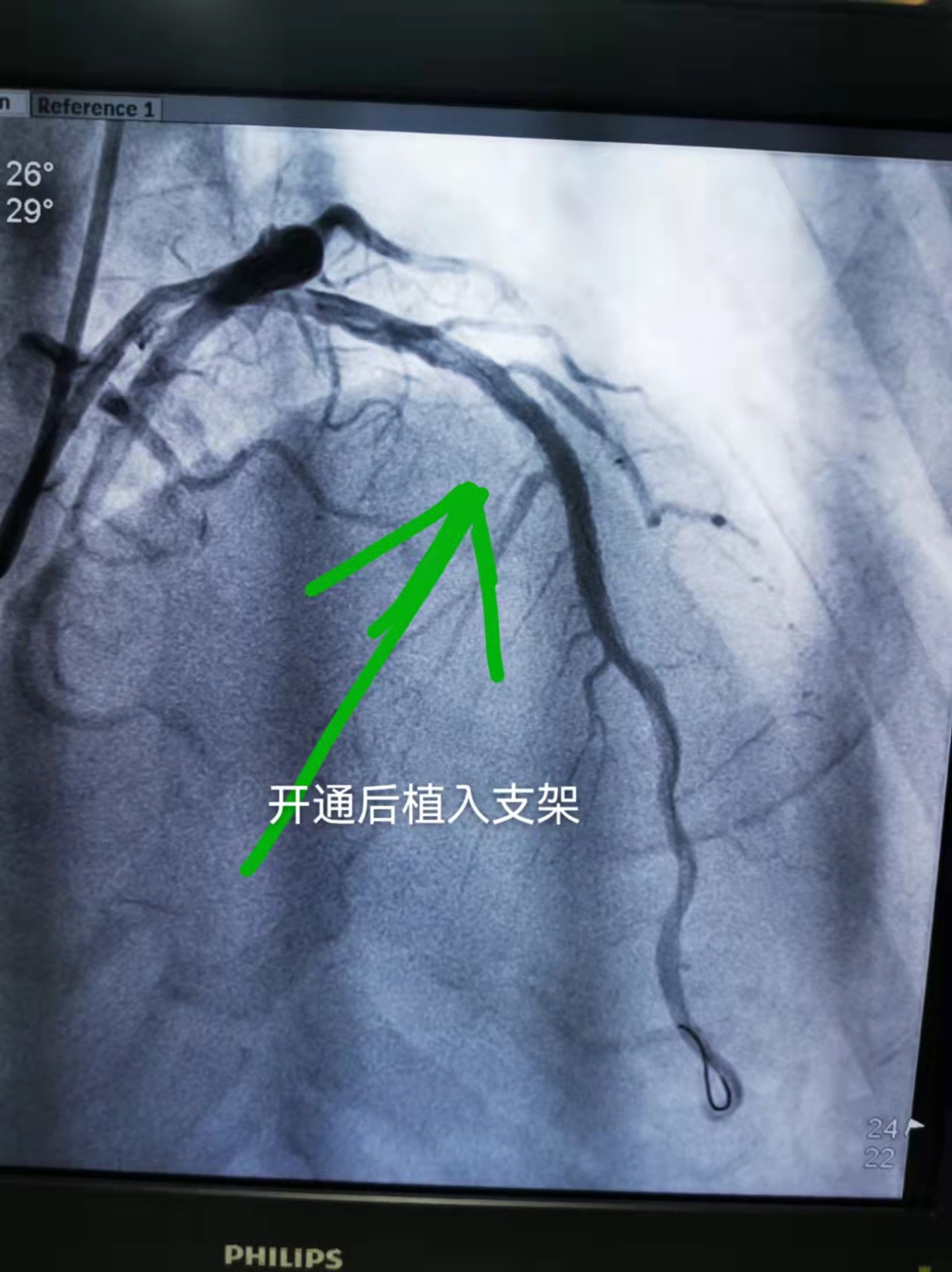 52分钟KO死神，我院极速抢救急性心梗患者！(图3)