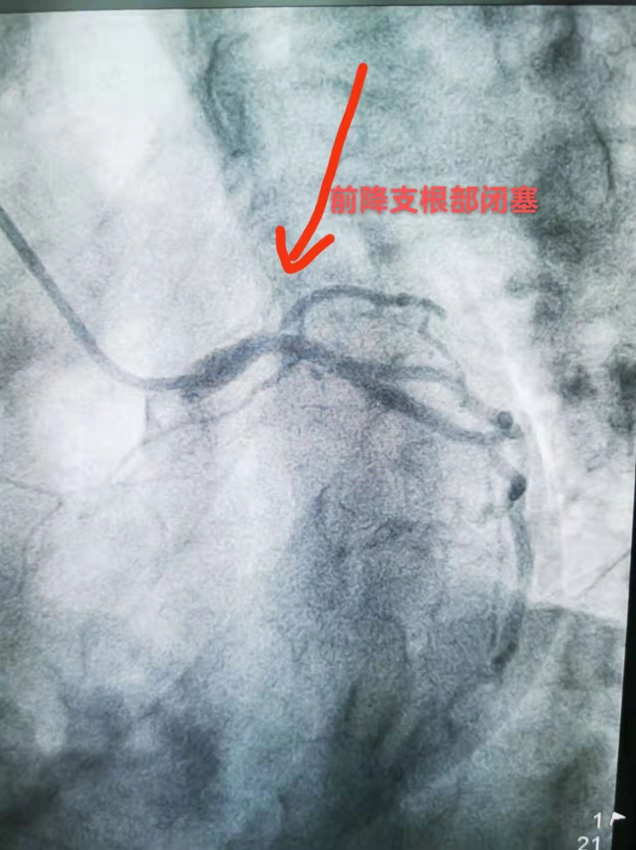 突破！我院完成首例冠脉慢性完全闭塞手术(图1)