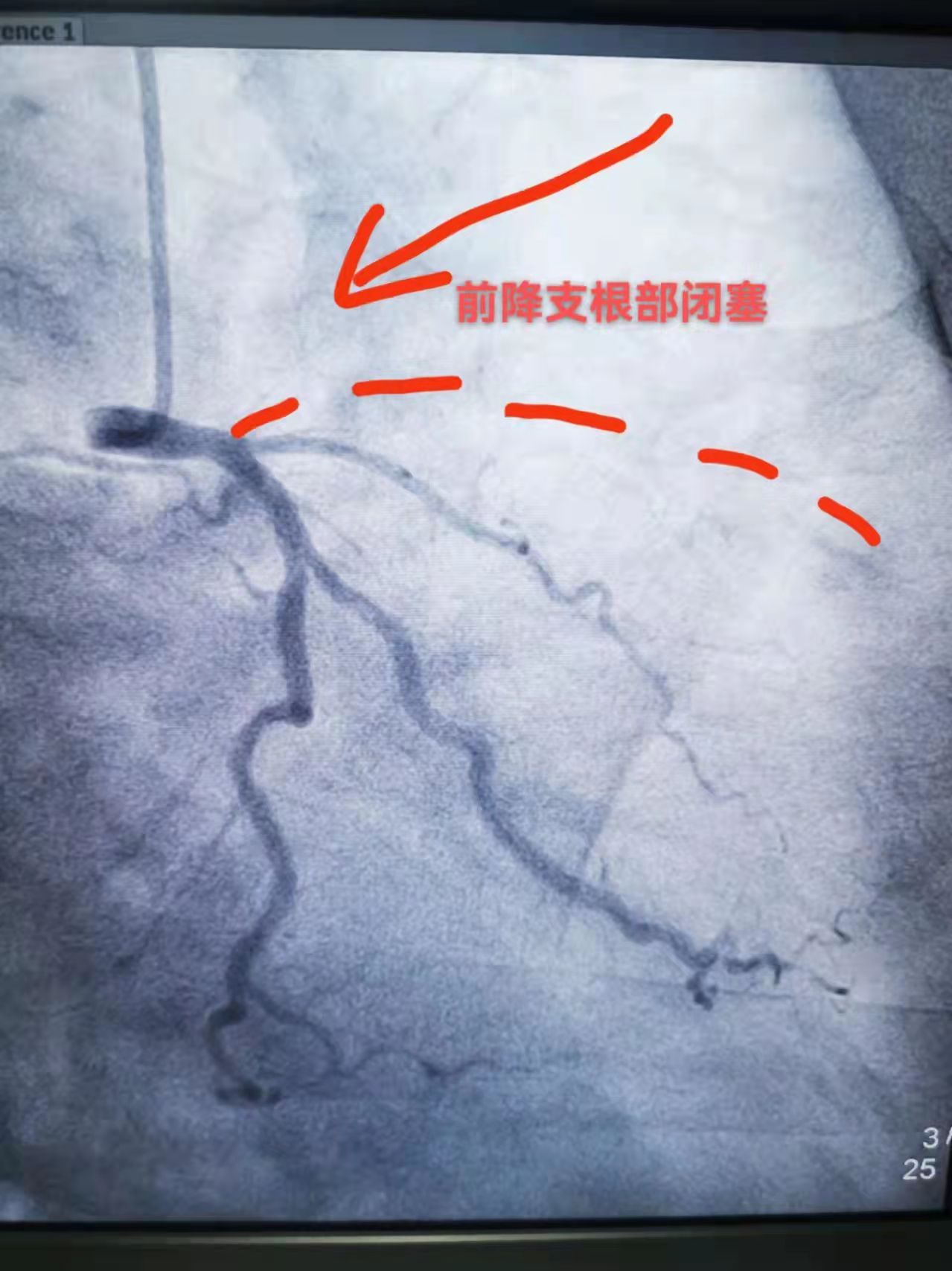 突破！我院完成首例冠脉慢性完全闭塞手术(图2)