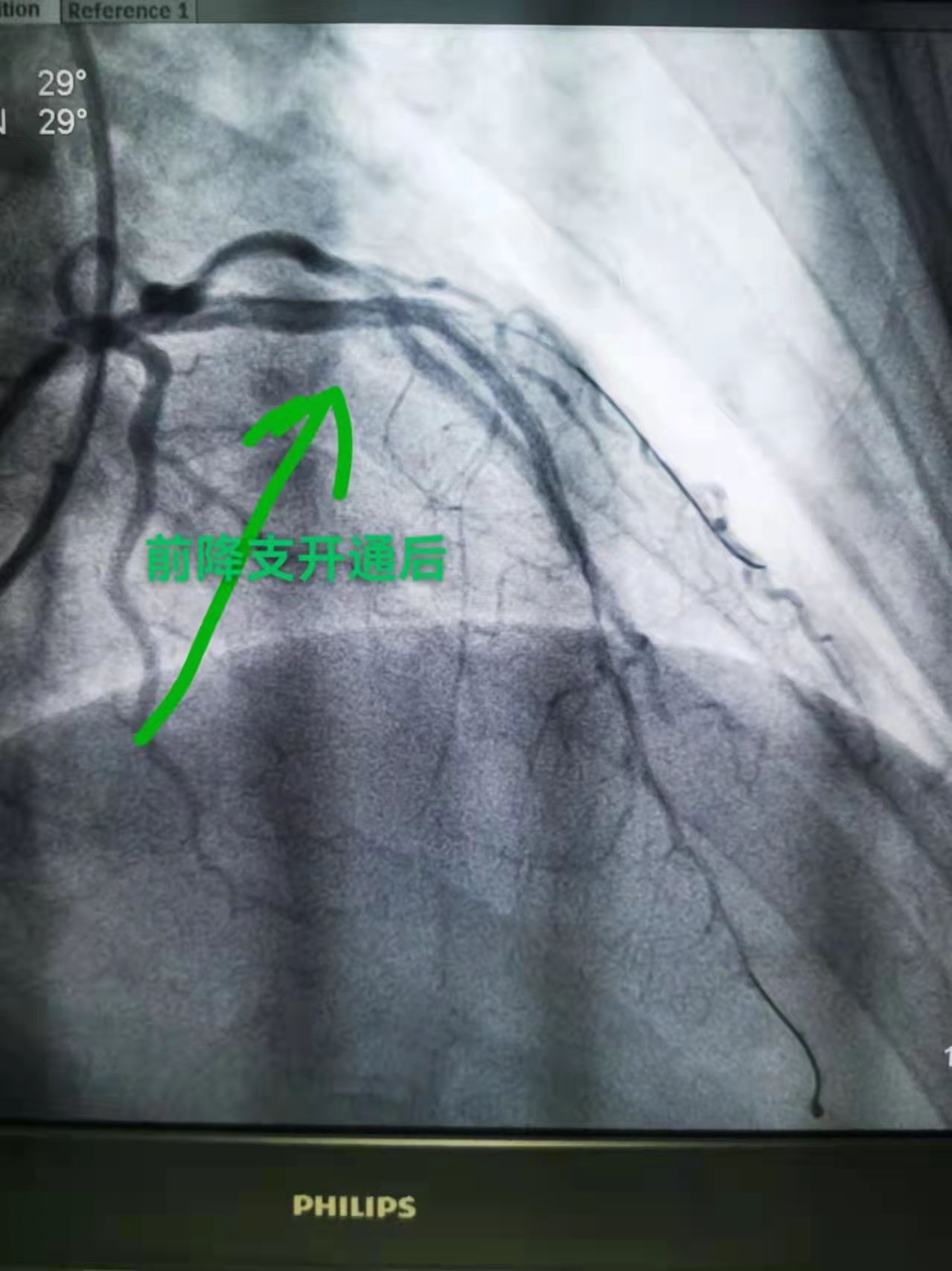 突破！我院完成首例冠脉慢性完全闭塞手术(图3)