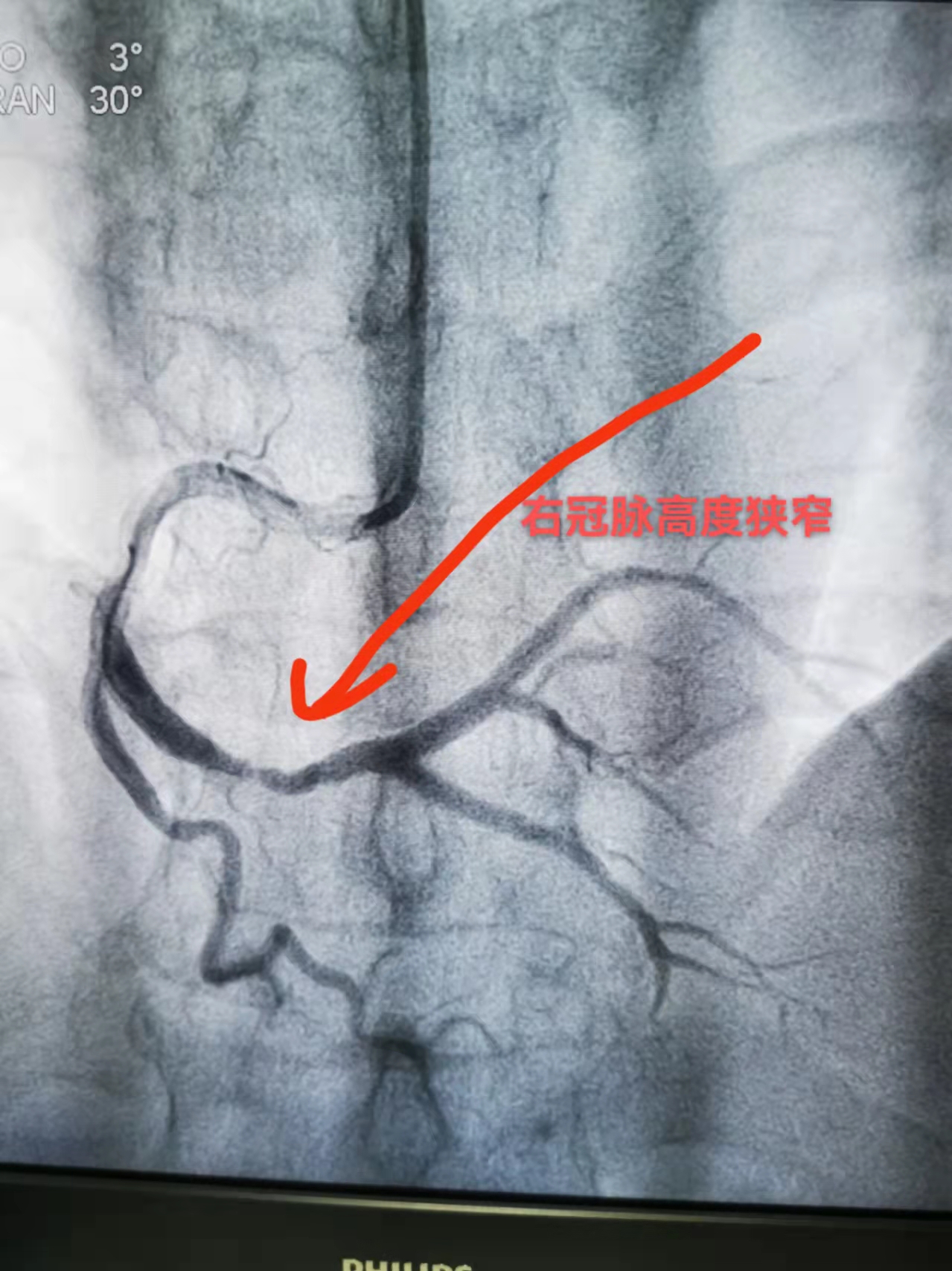 生死时速！我院多学科接力合作成功救治急性心梗患者(图2)