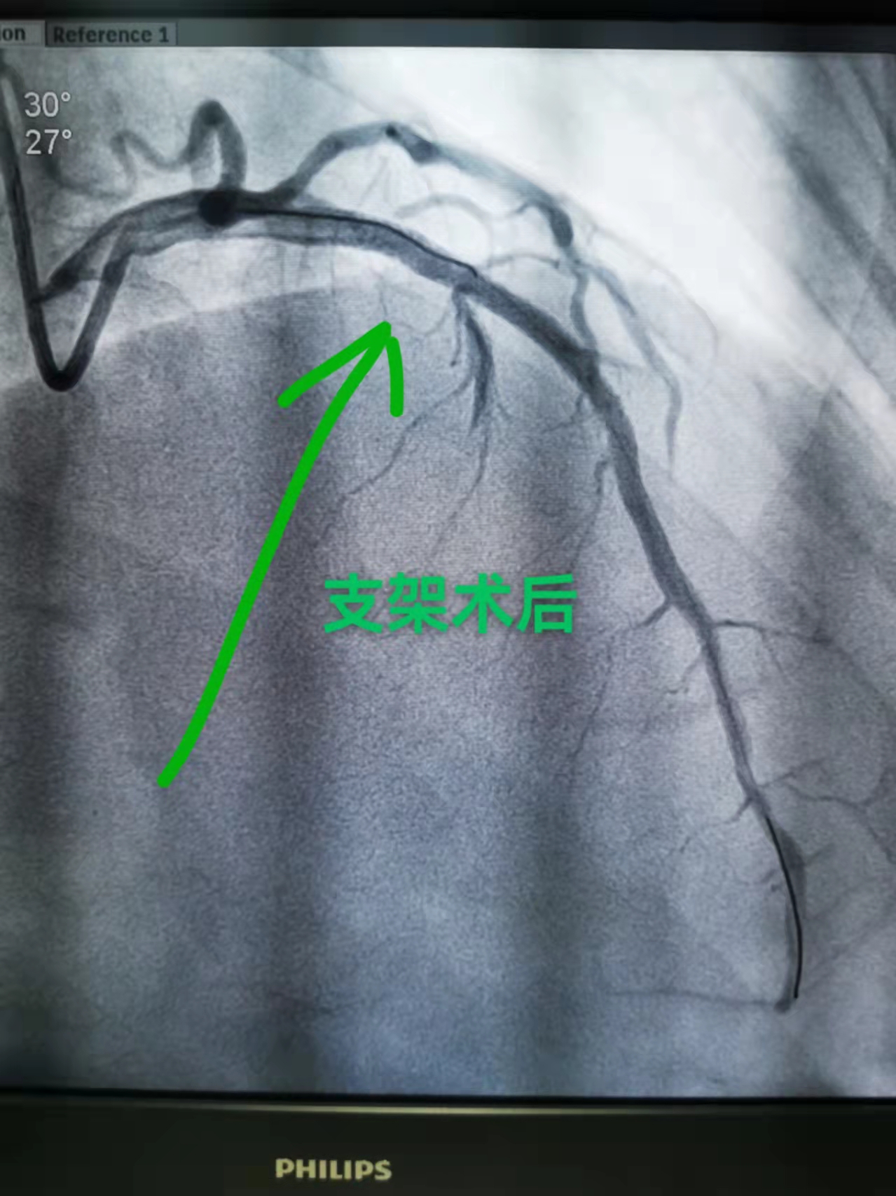 生死时速！我院多学科接力合作成功救治急性心梗患者(图3)