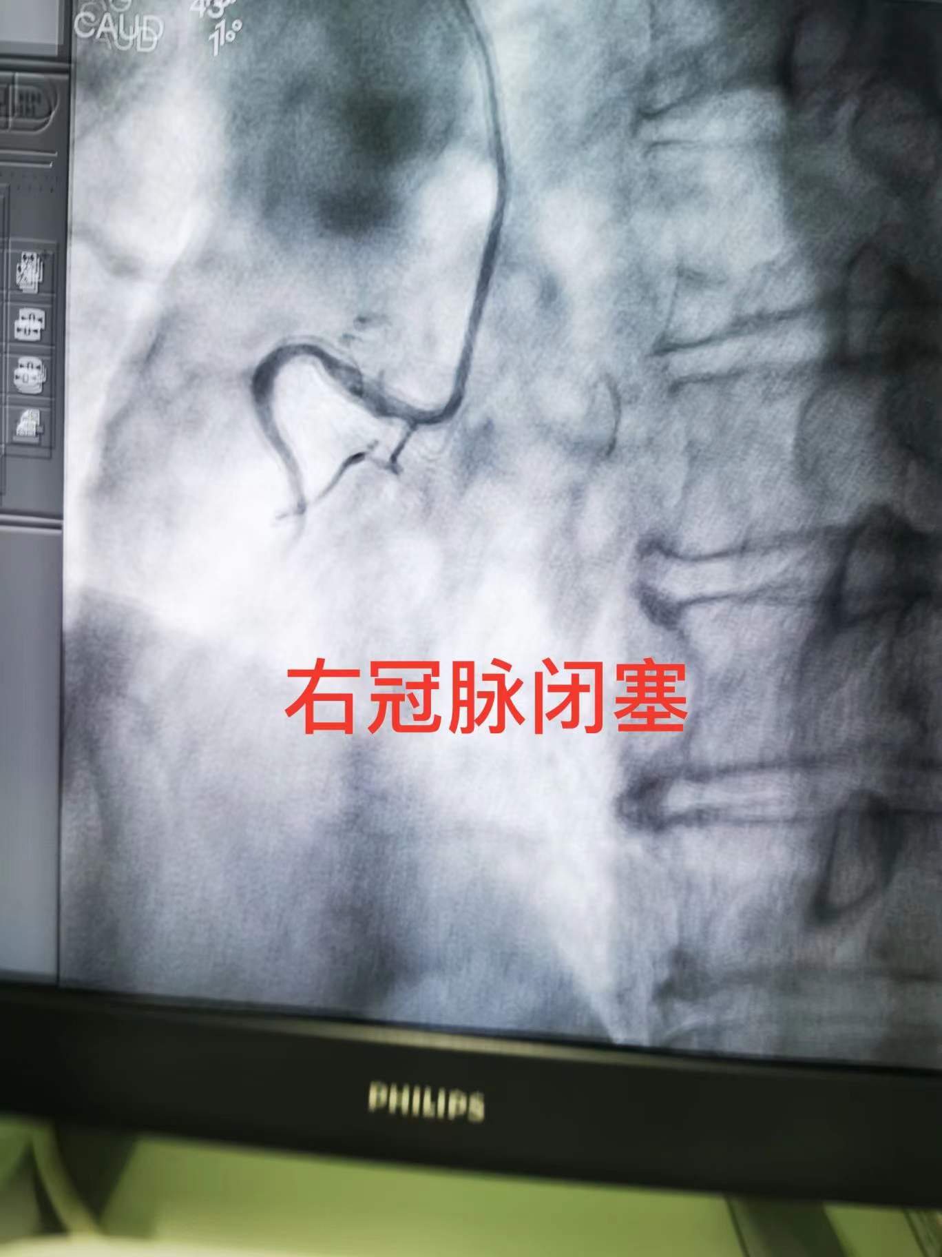 25分钟打通堵塞血管 我院诞生救治心梗患者新纪录(图1)