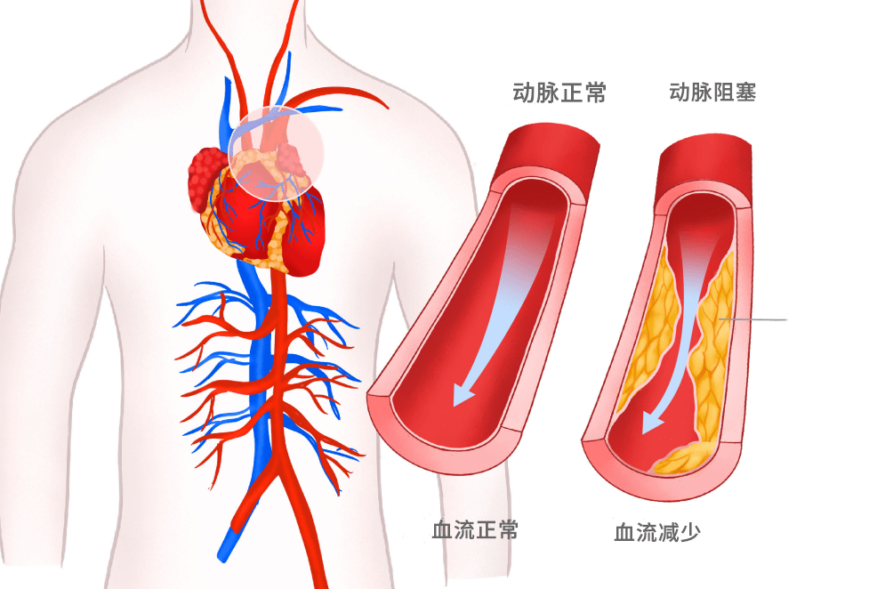 支架不是万能的：44岁男子“放纵”后再次心梗(图1)