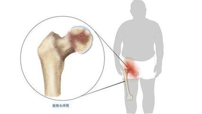 十八周年庆-股骨头血管融通术，解决股骨头早期坏死难题(图1)