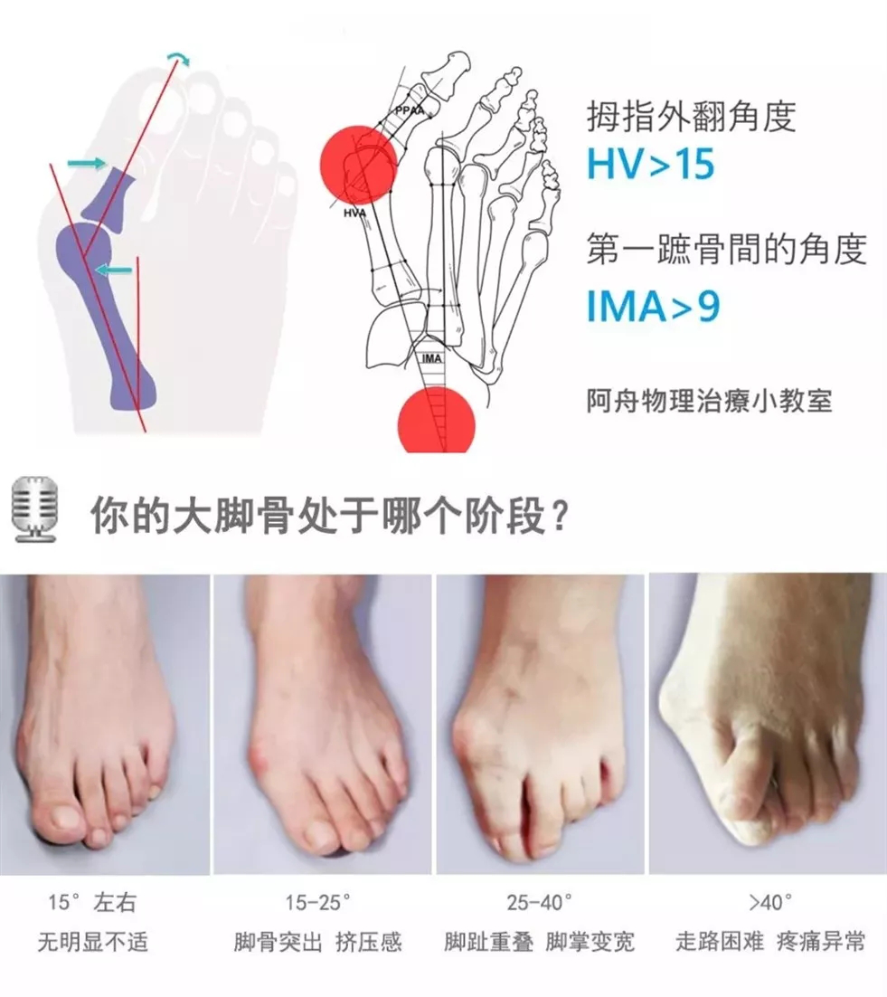 纠正如换脚，微创告别拇外翻(图1)