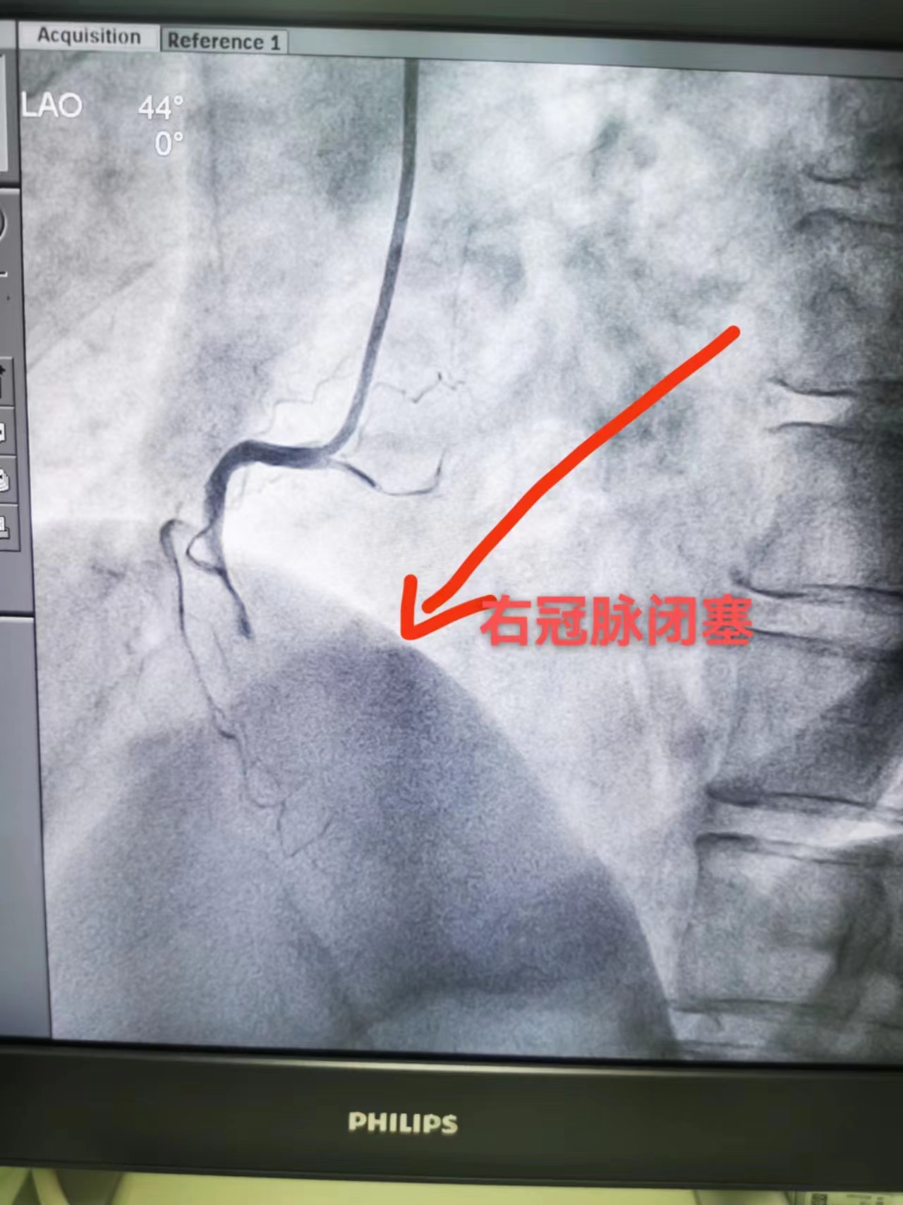 六旬老人凌晨心梗，“救心”专家紧急介入转危为安(图2)