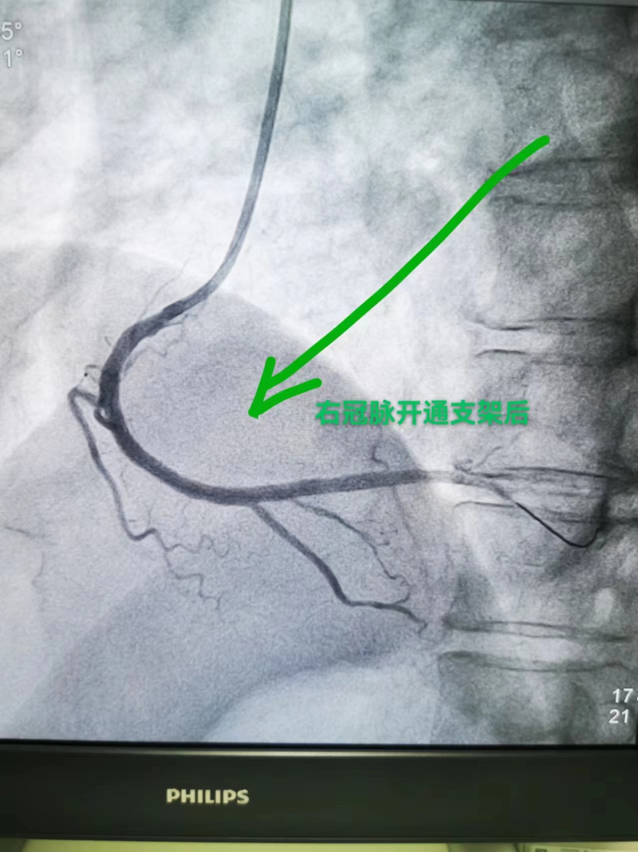 六旬老人凌晨心梗，“救心”专家紧急介入转危为安(图3)