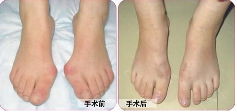 微创矫形拇外翻，让女性足不痛苦，穿鞋自由(图1)