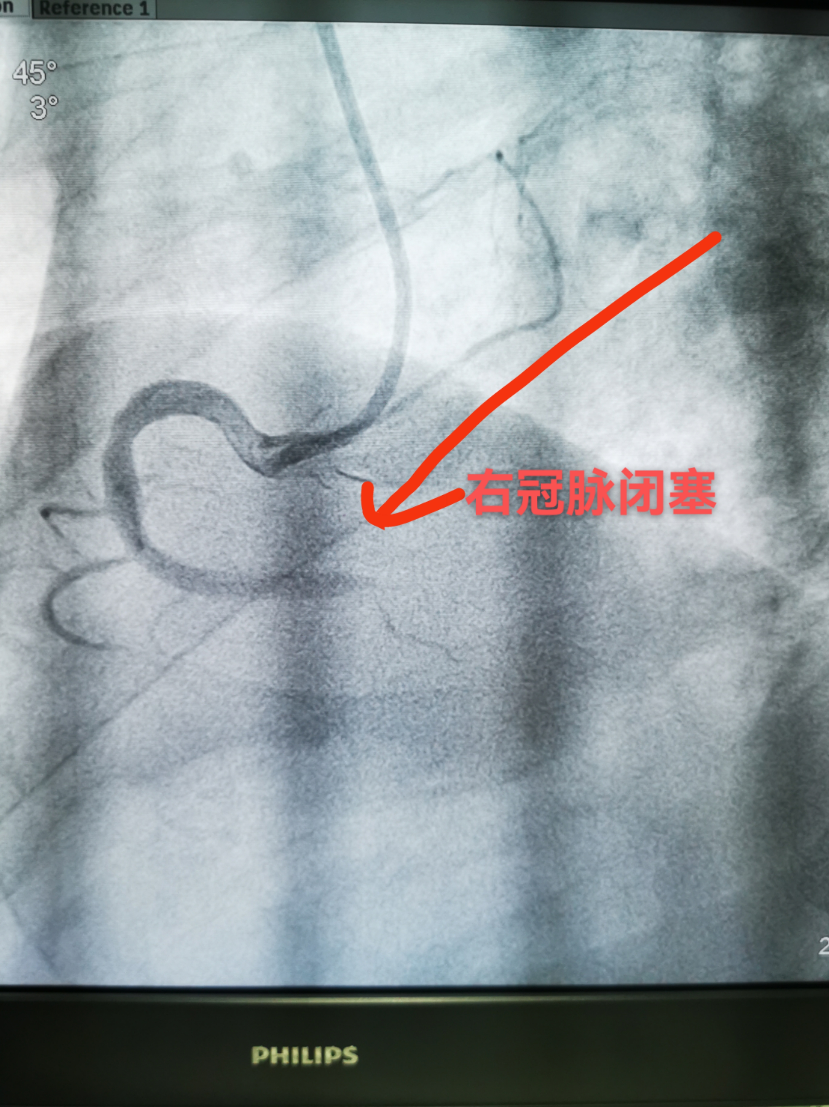 争分夺秒救心梗！38分钟“门球时间”跑赢死神(图1)