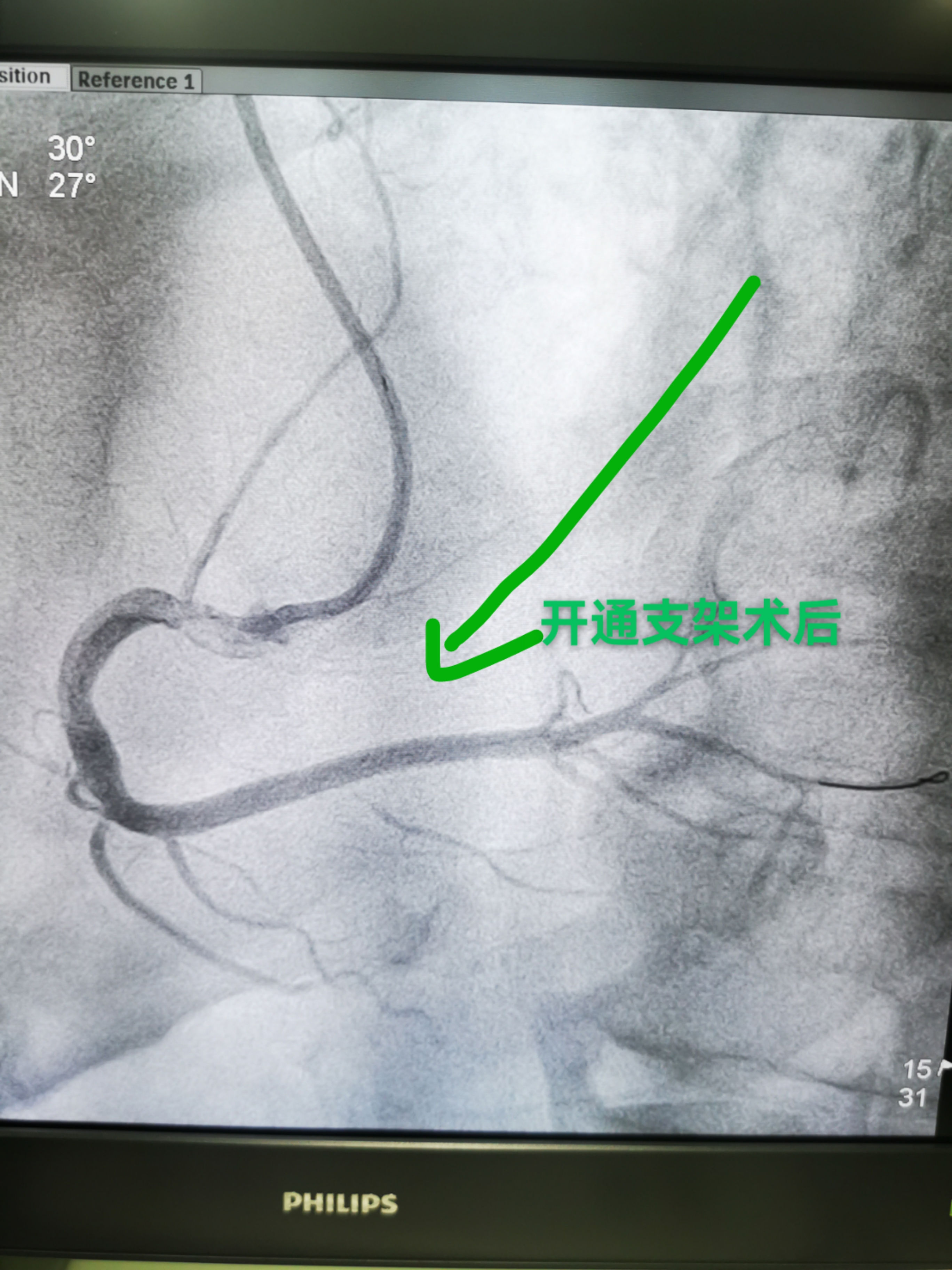争分夺秒救心梗！38分钟“门球时间”跑赢死神(图2)