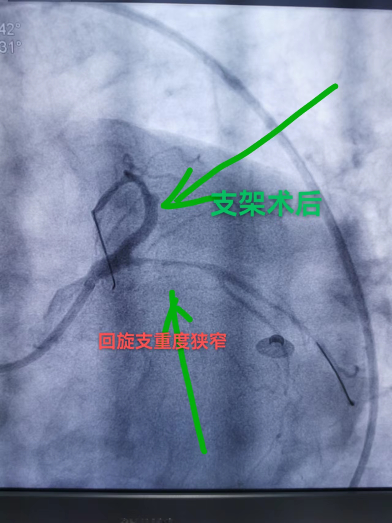 生死时速-命悬一线的“三支病变”危重患者“重生记”(图3)