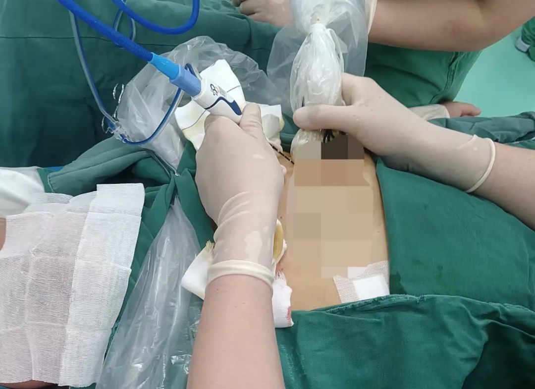 以针代刀、保乳无痕，乳腺微波消融术轻松解难题(图2)