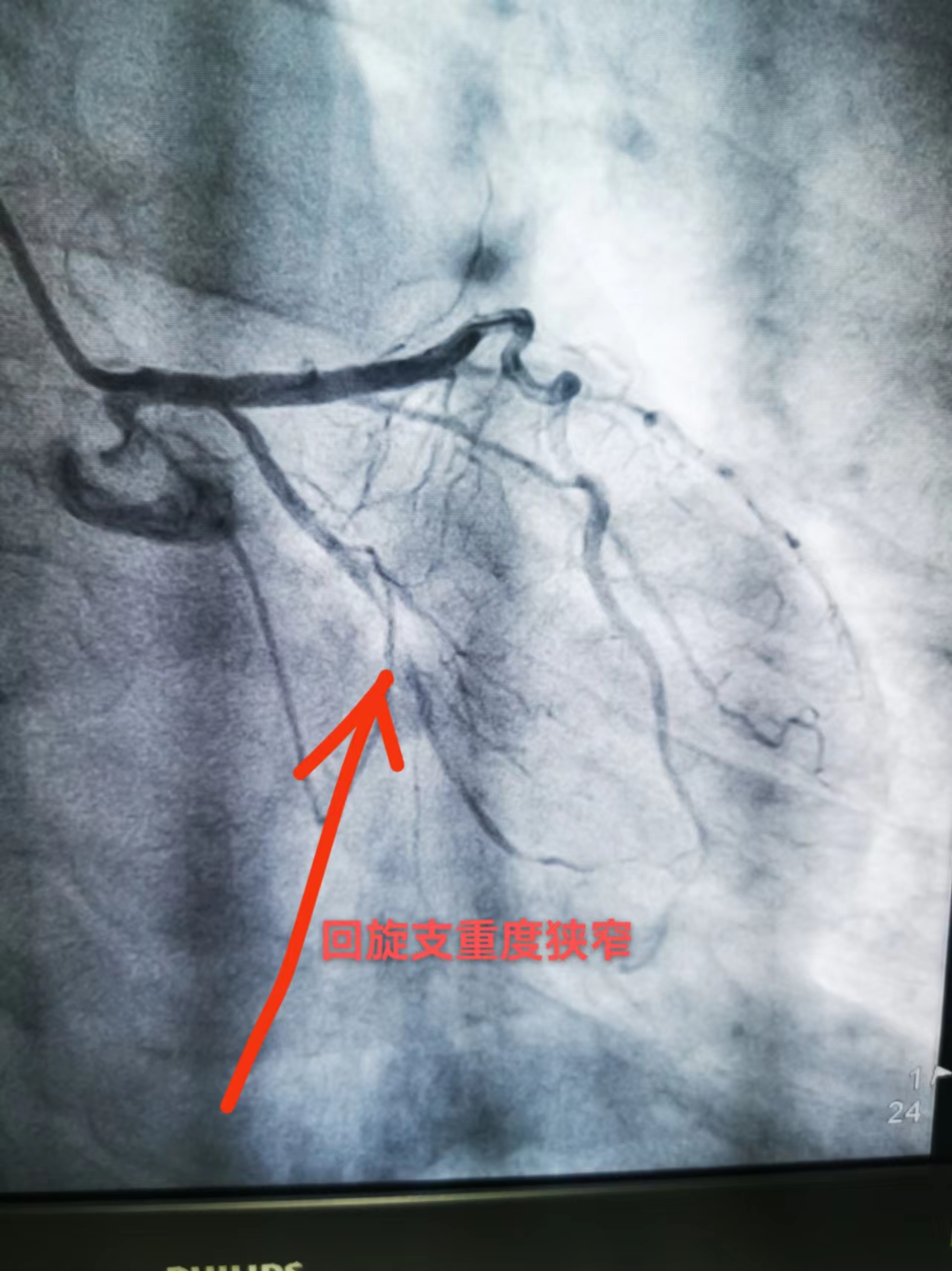 46分钟生死竞速！他们成功将心肌梗死患者从鬼门关拉回来(图1)