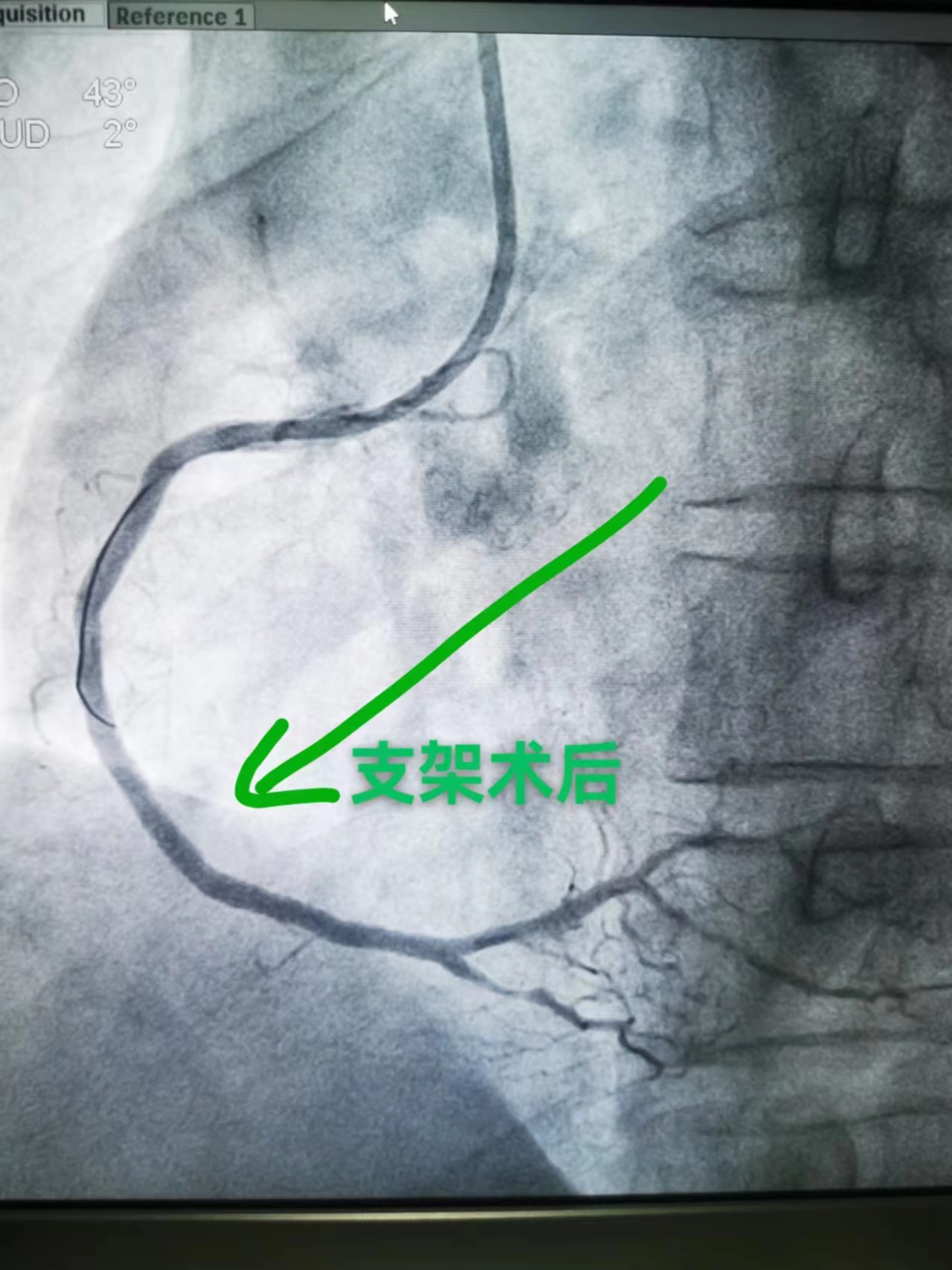 46分钟生死竞速！他们成功将心肌梗死患者从鬼门关拉回来(图3)