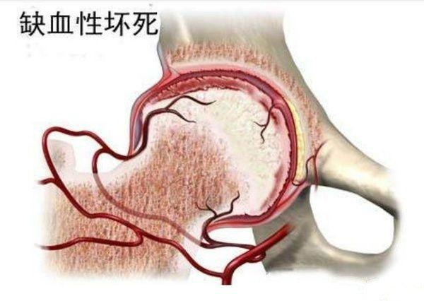 股骨头血管融通术，助你余生不再“颠簸”(图2)
