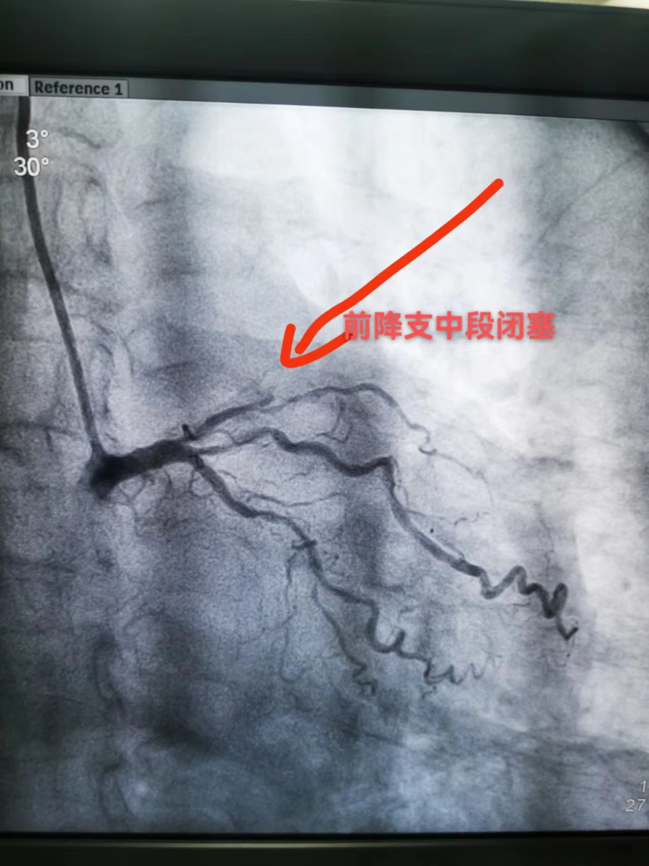 生死时速--“救心”专家培训、救治两不误(图5)