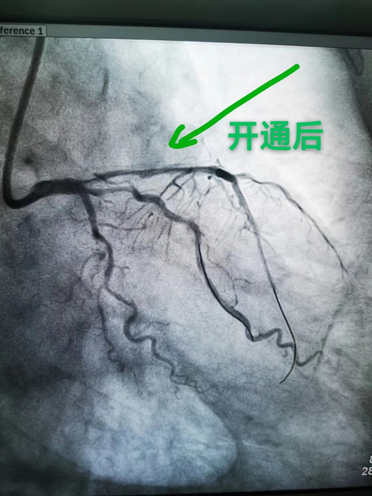 生死时速--“救心”专家培训、救治两不误(图7)