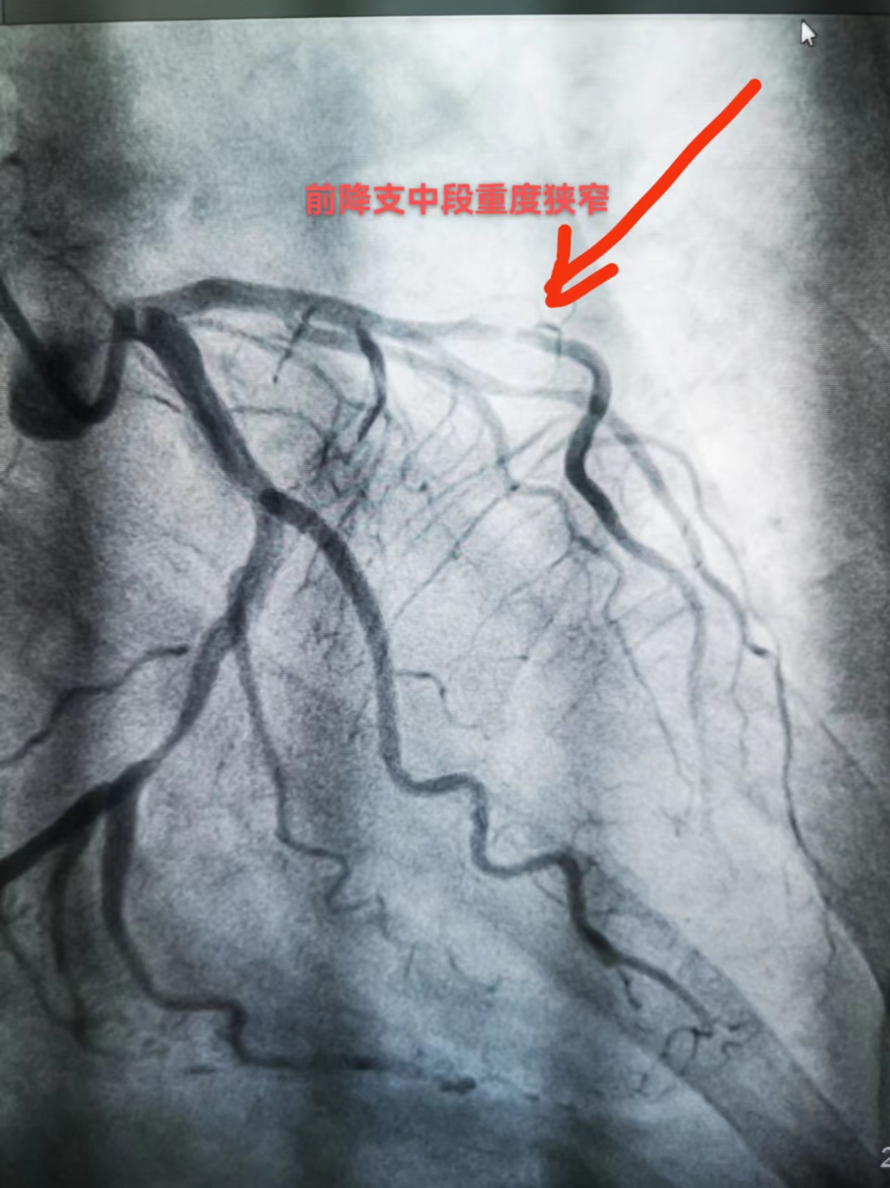 打通救心“高速路”，心梗患者成功获救(图2)