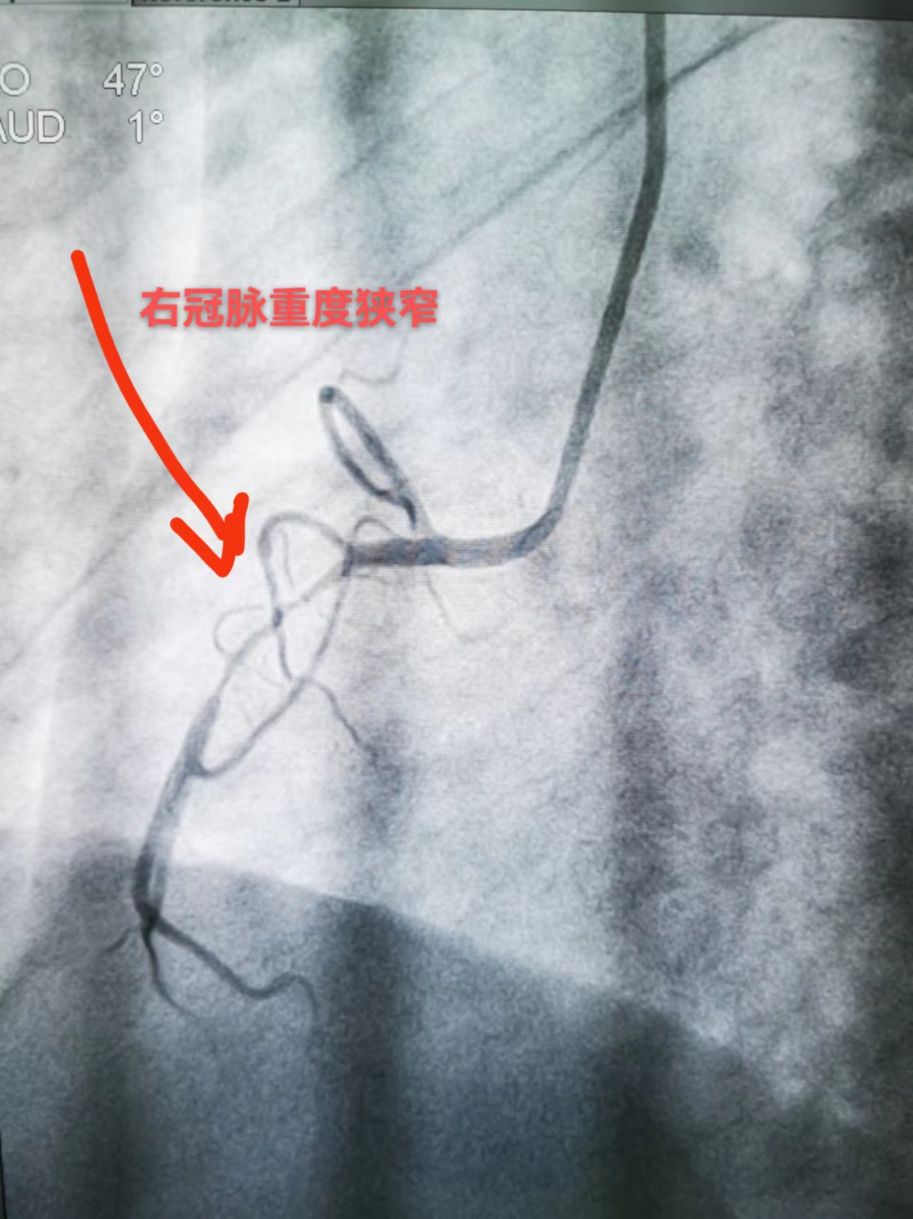 打通救心“高速路”，心梗患者成功获救(图3)