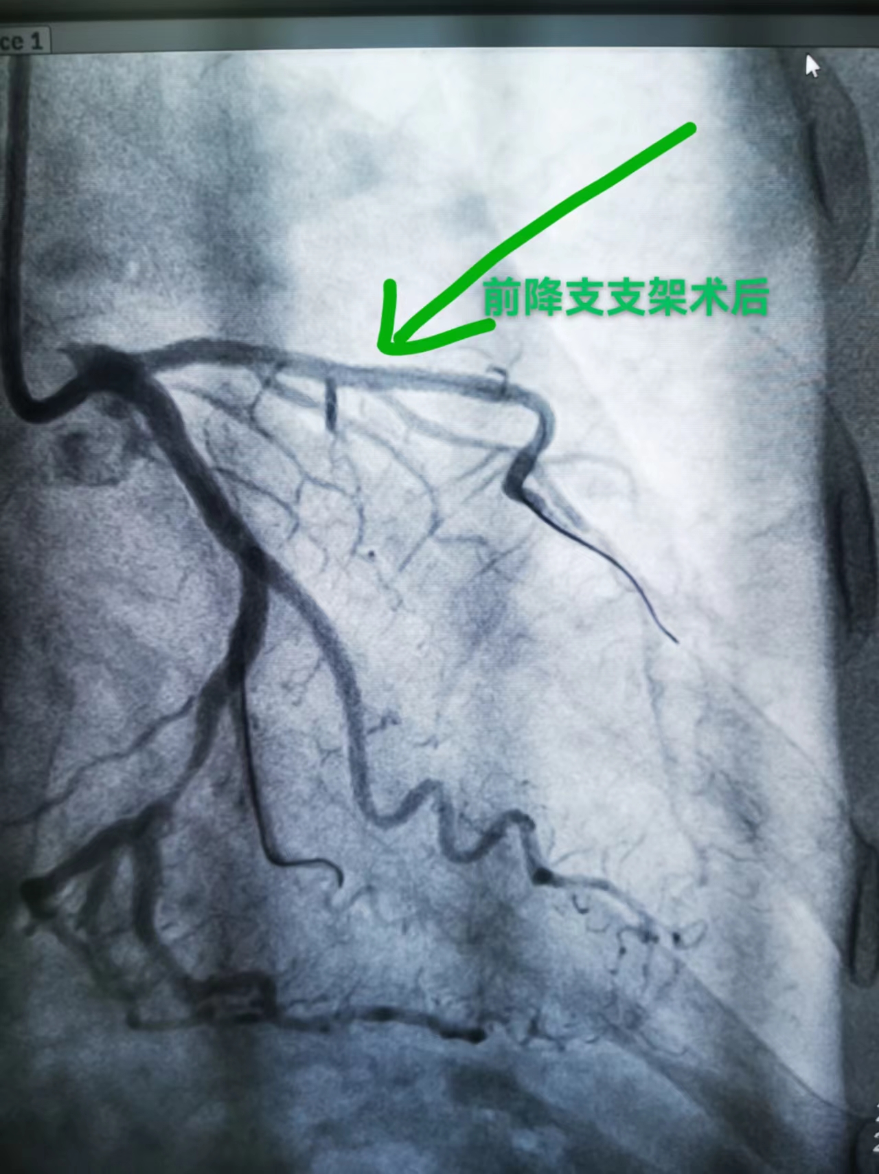 打通救心“高速路”，心梗患者成功获救(图5)