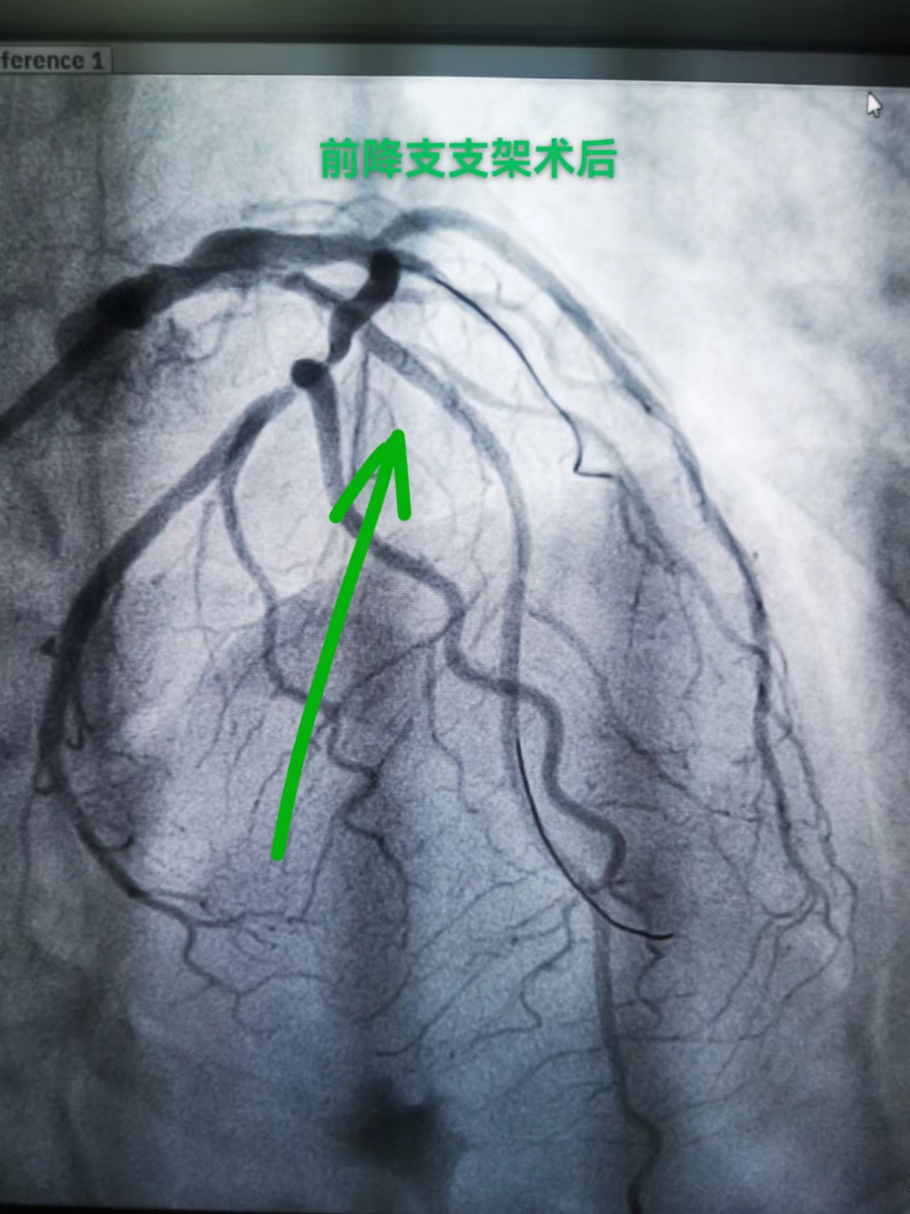 打通救心“高速路”，心梗患者成功获救(图4)