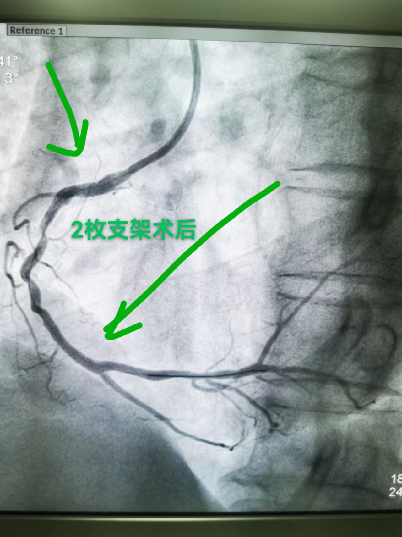 一并拿下！当急性心肌梗死遇上冠脉严重钙化(图3)