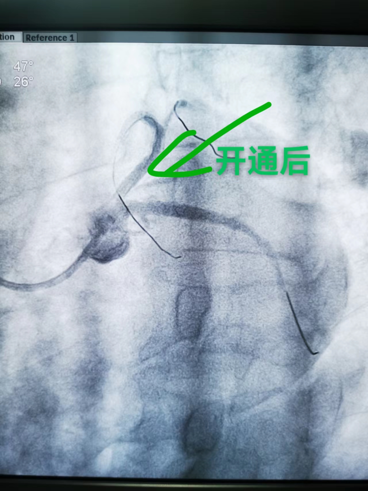 正逆向技术齐上阵，心梗患者绝处逢生(图4)