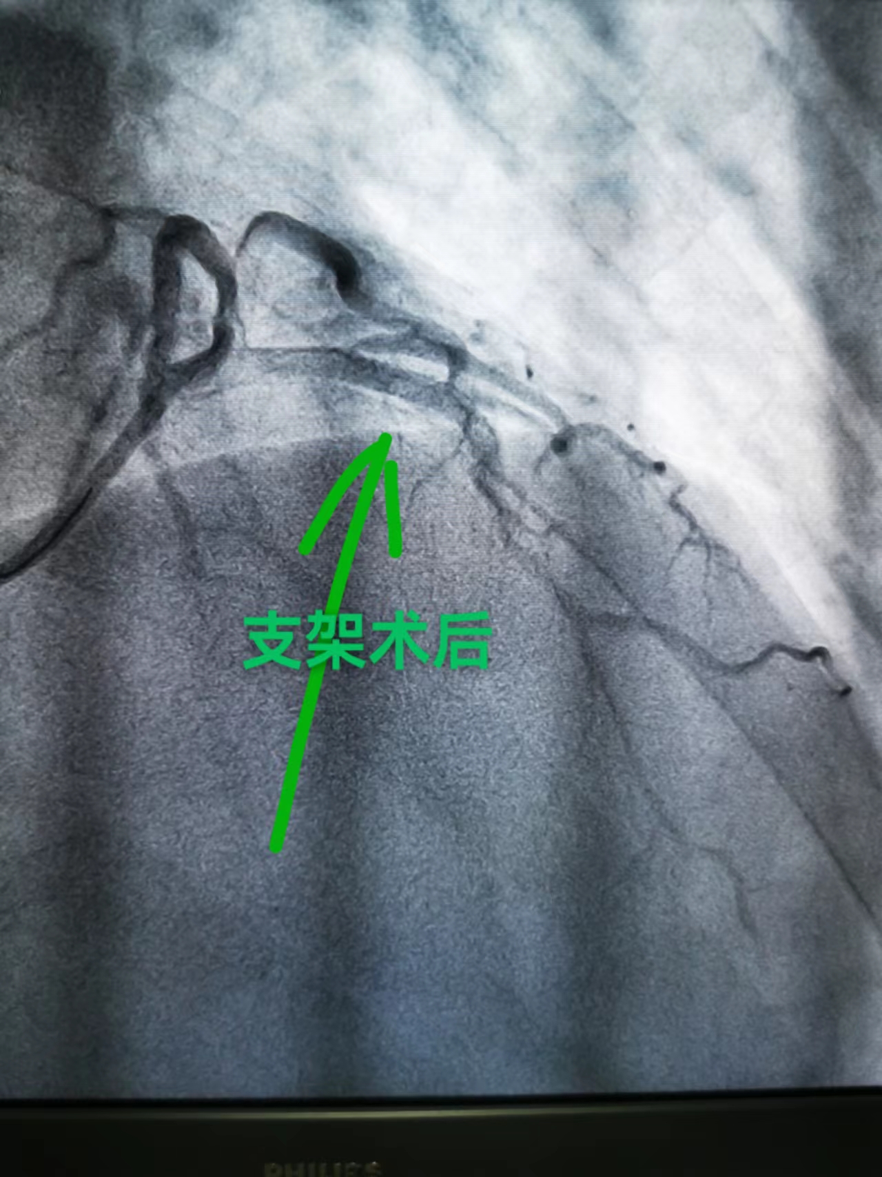 患者突发心梗生命垂危，39分钟紧急抢救转危为安(图3)