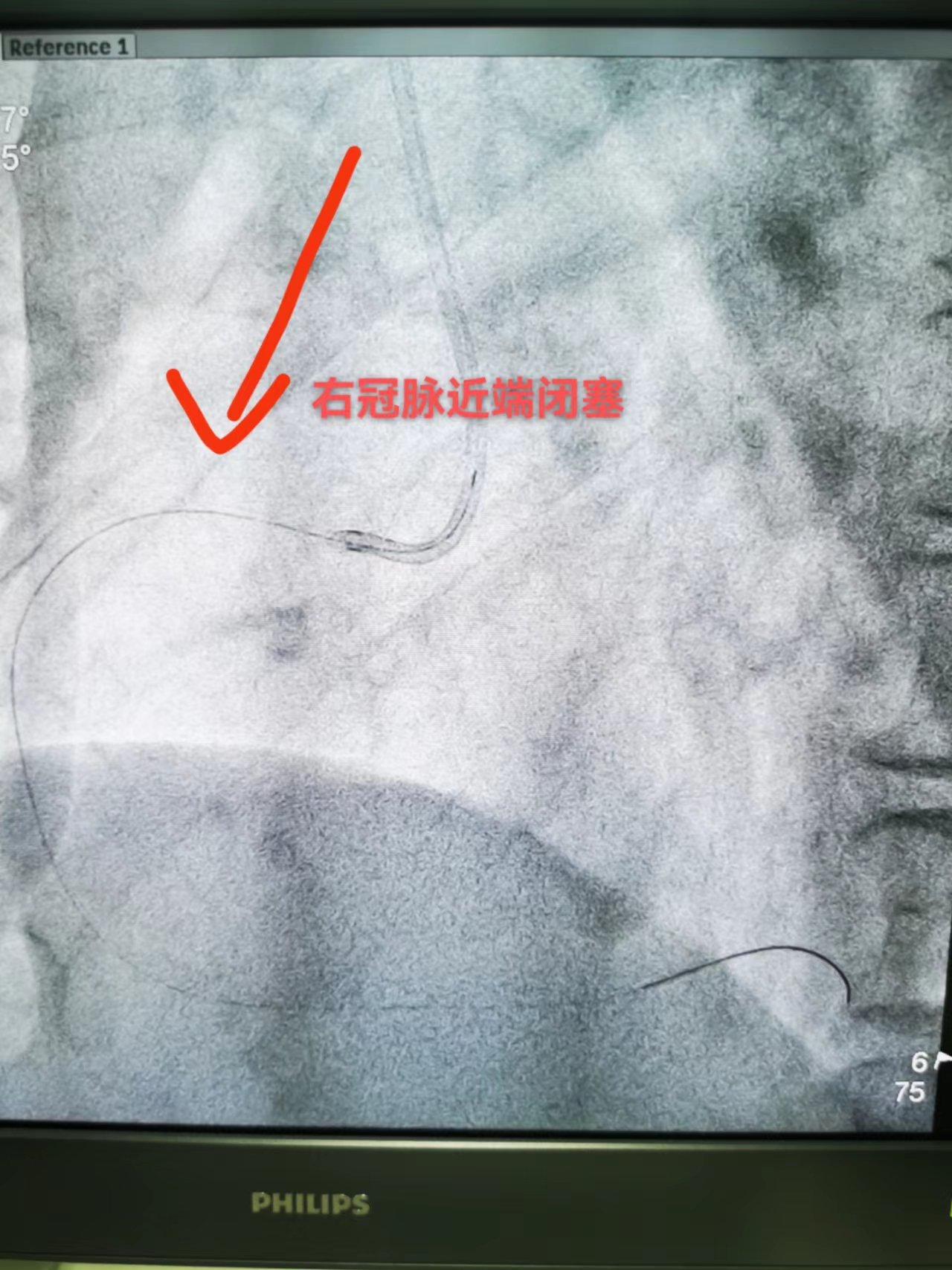 临时起搏器+冠脉介入治疗，助急性心梗患者连闯“鬼门关”(图2)