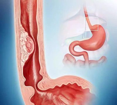 “双镜”联合出击，让65岁食管癌患者重拾人间烟火味(图1)