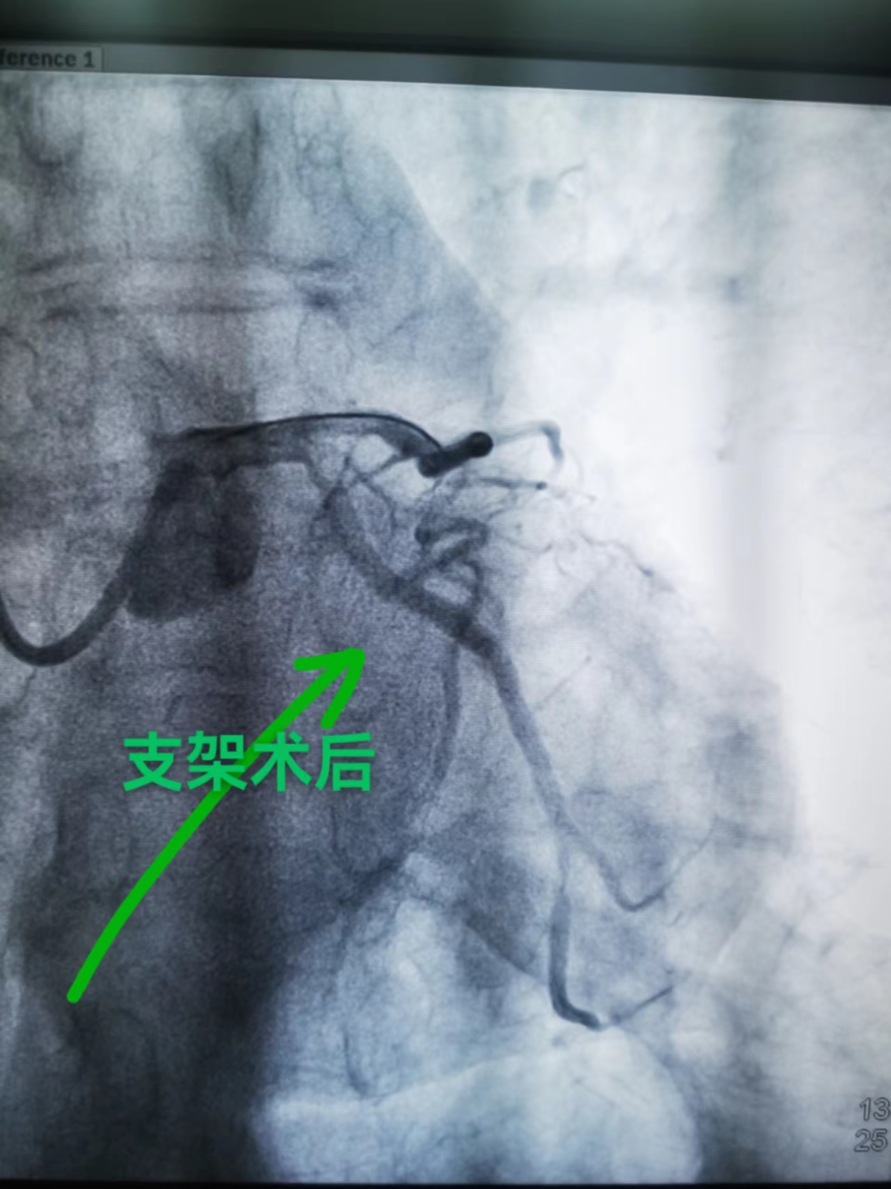 急性心梗再起“风暴”，“救心”专家接连救治心梗患者(图7)