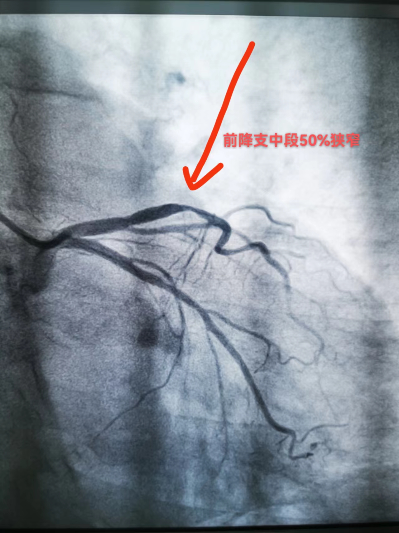 急性心梗再起“风暴”，“救心”专家接连救治心梗患者(图1)