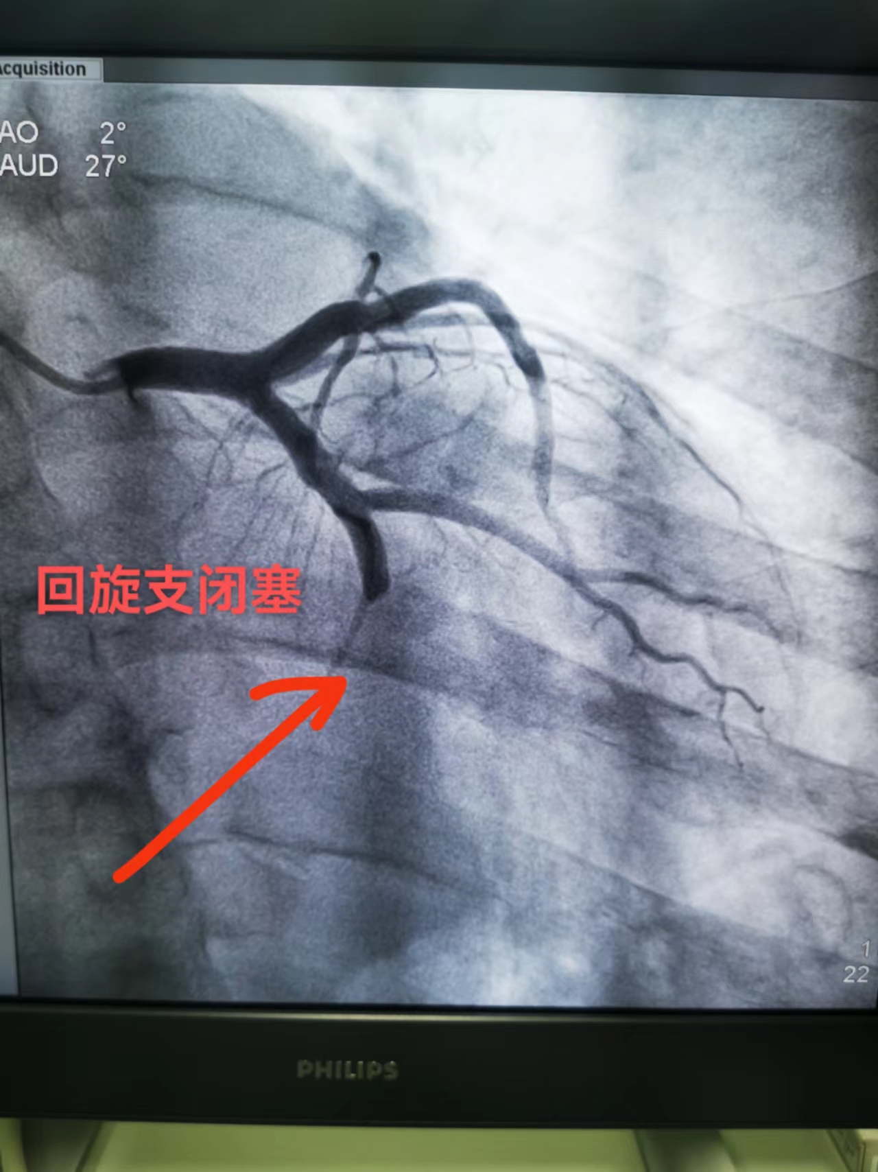 “病”贵神速，急性心梗患者50分钟成功脱险(图1)
