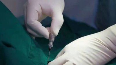 射频消融术，不开刀治疗“难缠”颈椎病(图2)
