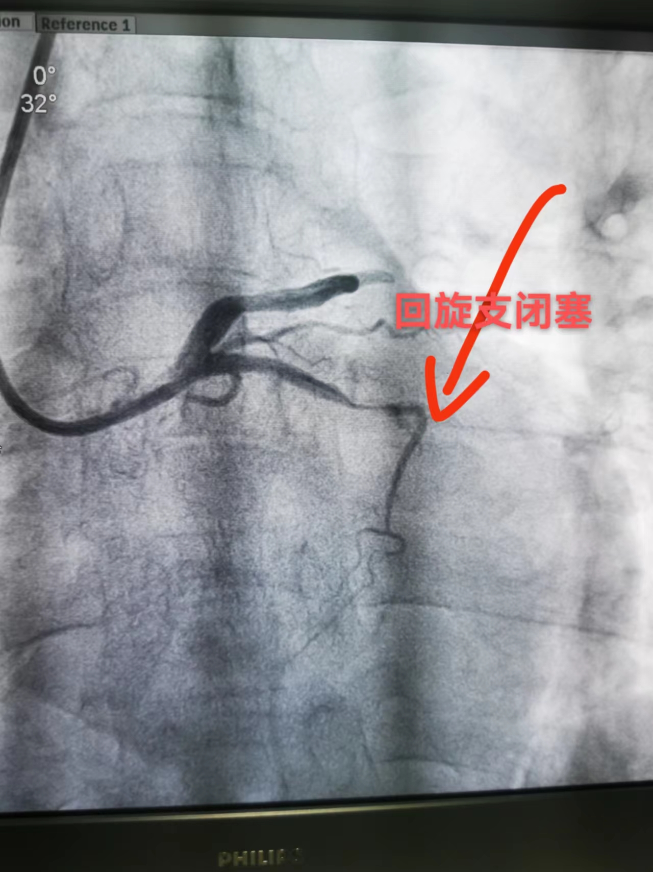 多路通“心”--拇指旁穿刺入路助心梗患者闯关成功(图1)