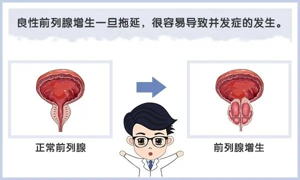 震撼！不开刀切掉超大增生前列腺(图2)