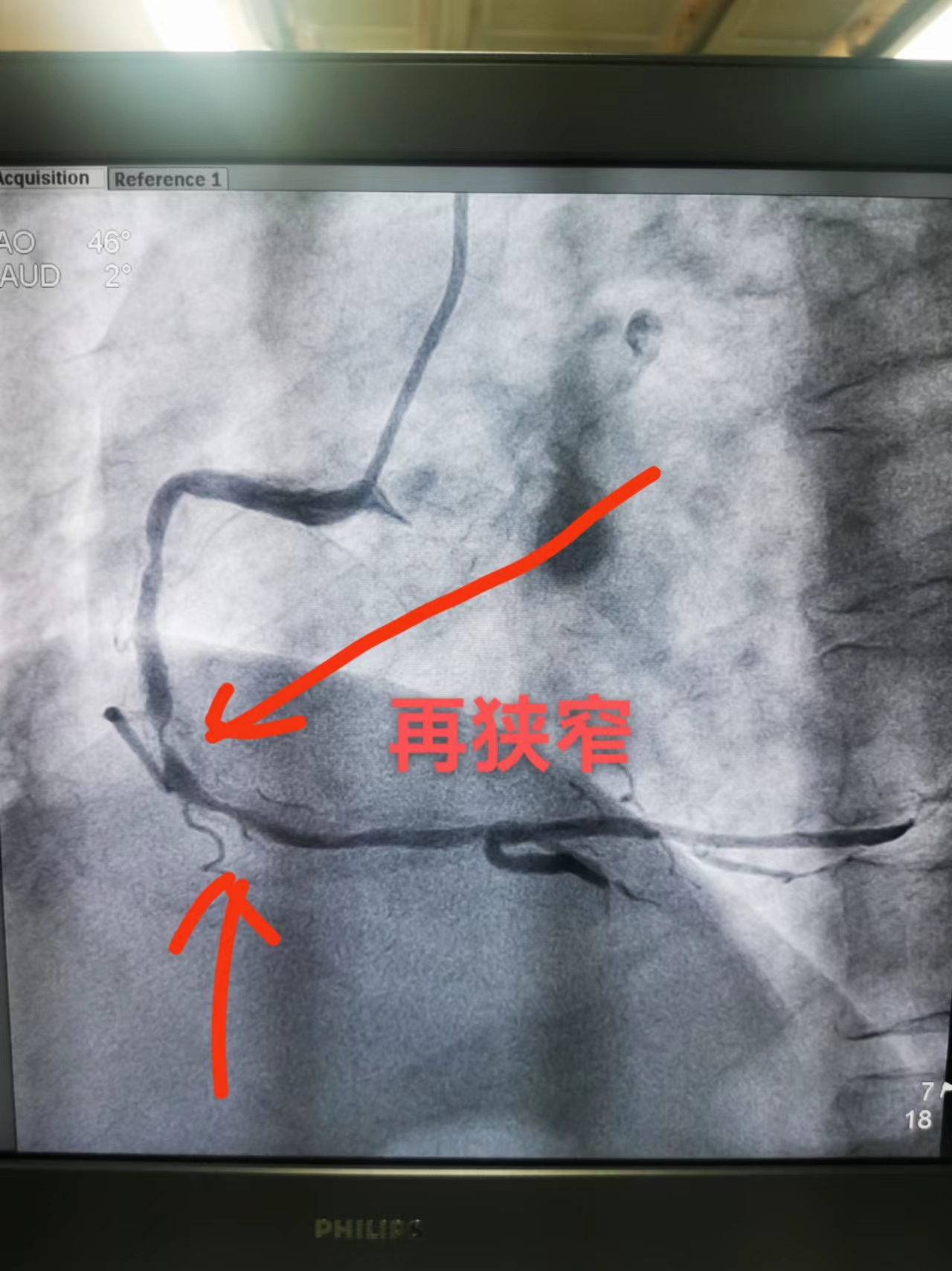 我院完成首例支架内再狭窄患者药物球囊治疗(图1)