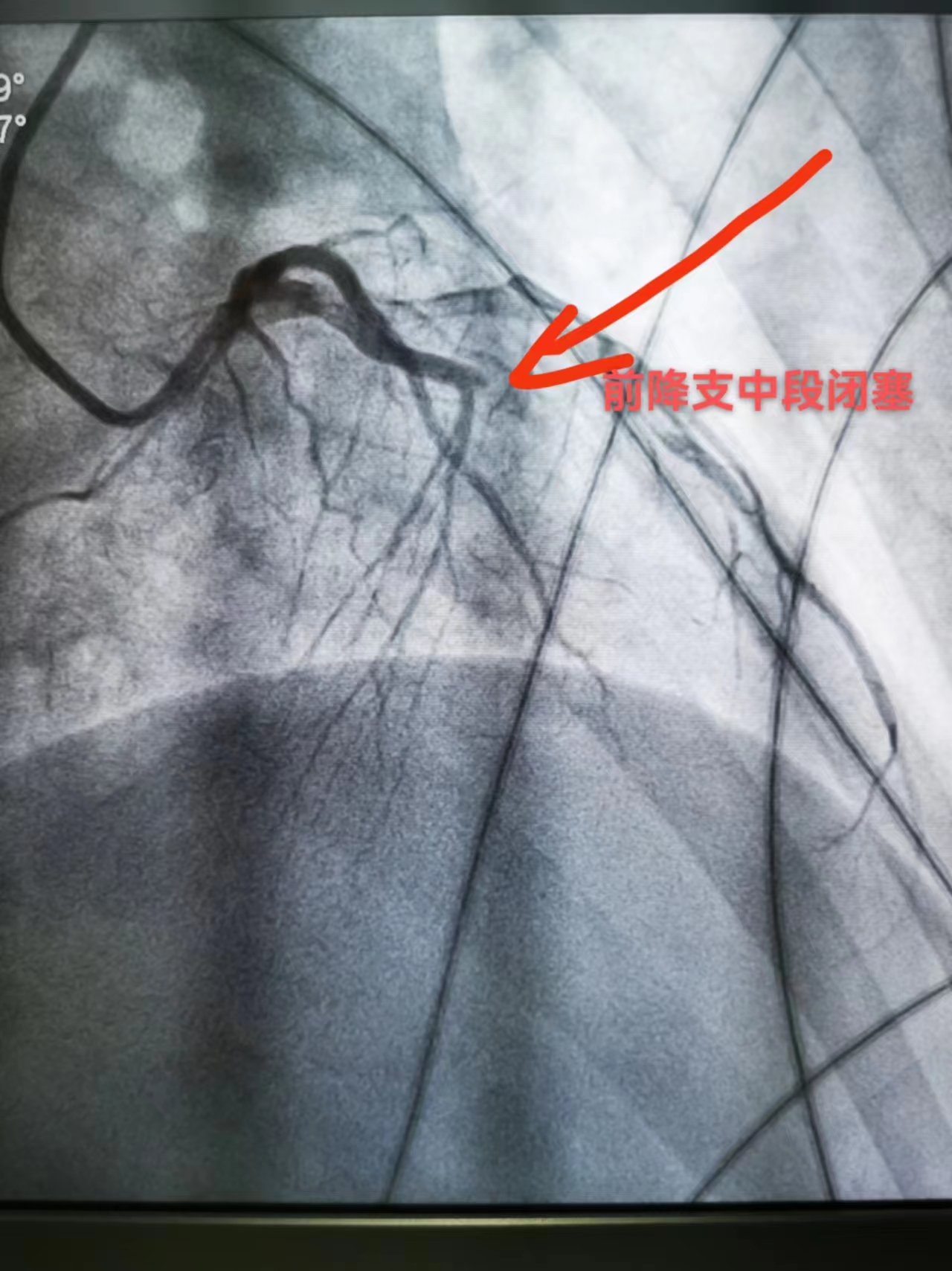 心肌梗死再遭室颤危机，多学科合力抢救唤“心”生(图1)