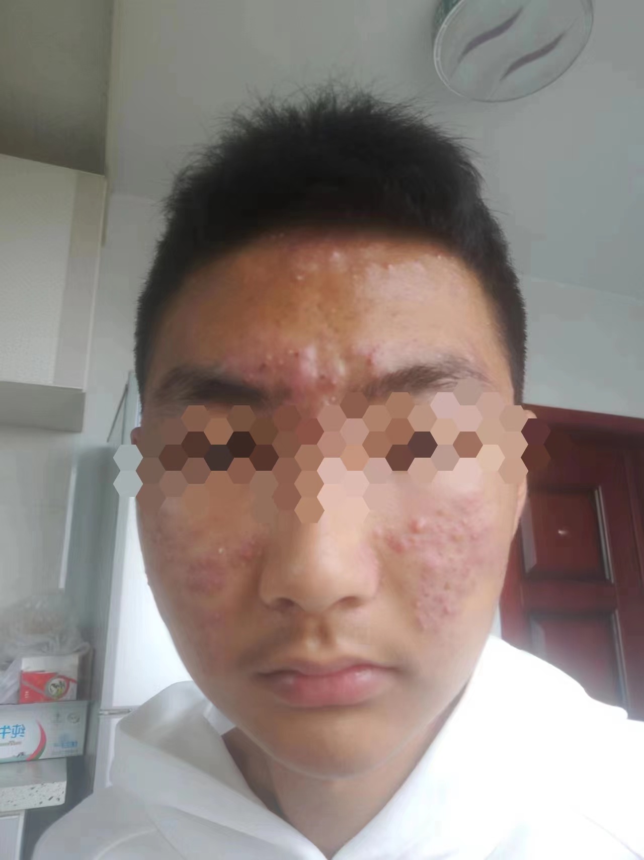 “痤疮”毁颜值，中医助你来“战痘”(图2)