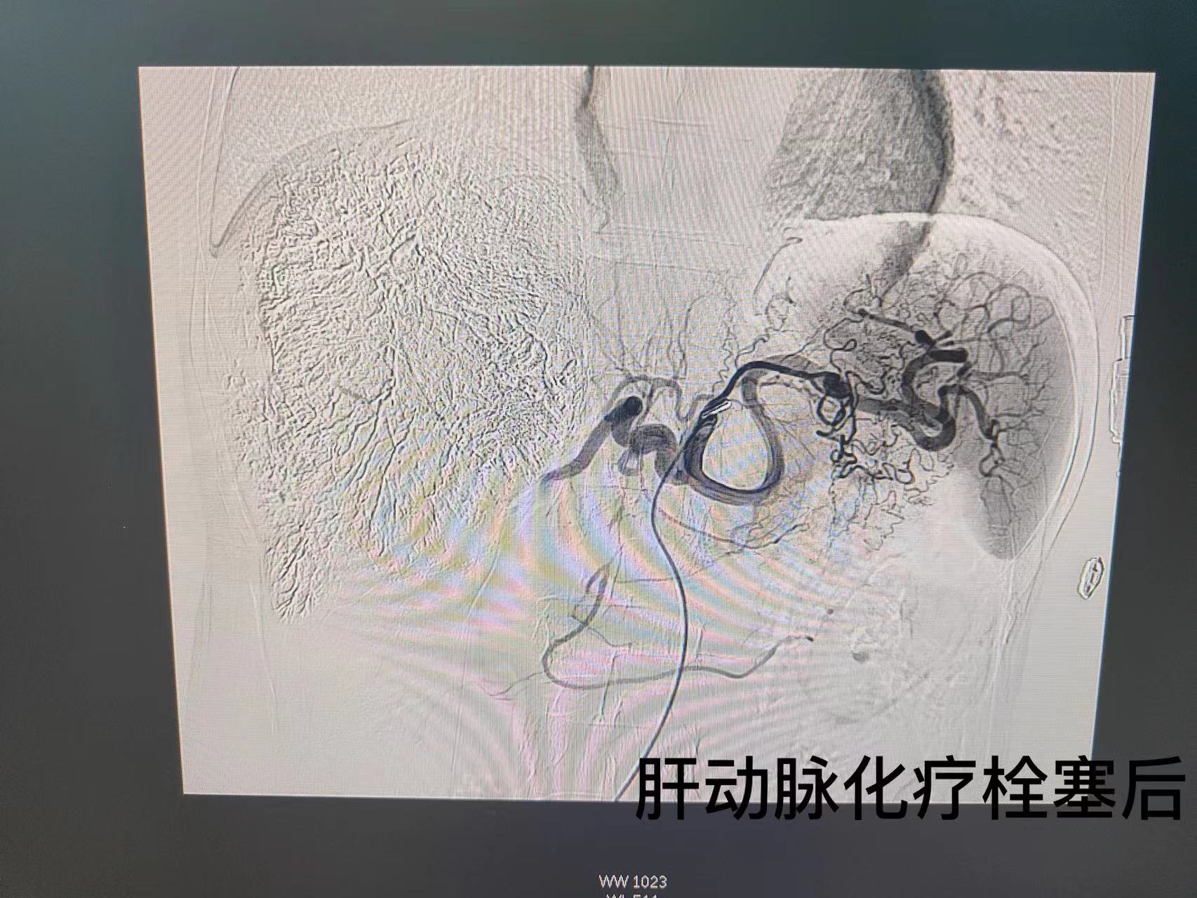 综合微创介入治疗，让恶性肝肿瘤患者绝处逢生(图2)