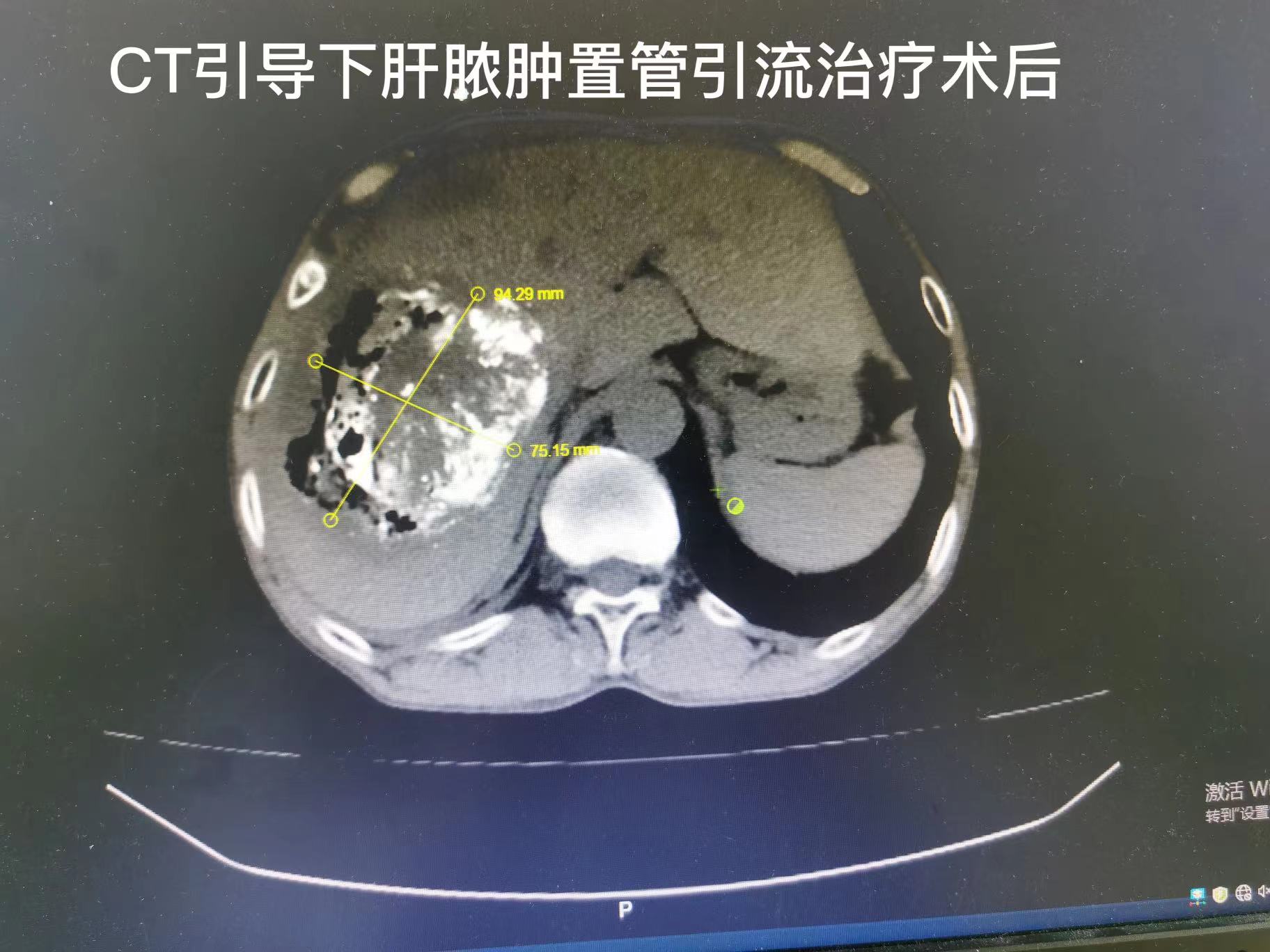 综合微创介入治疗，让恶性肝肿瘤患者绝处逢生(图3)